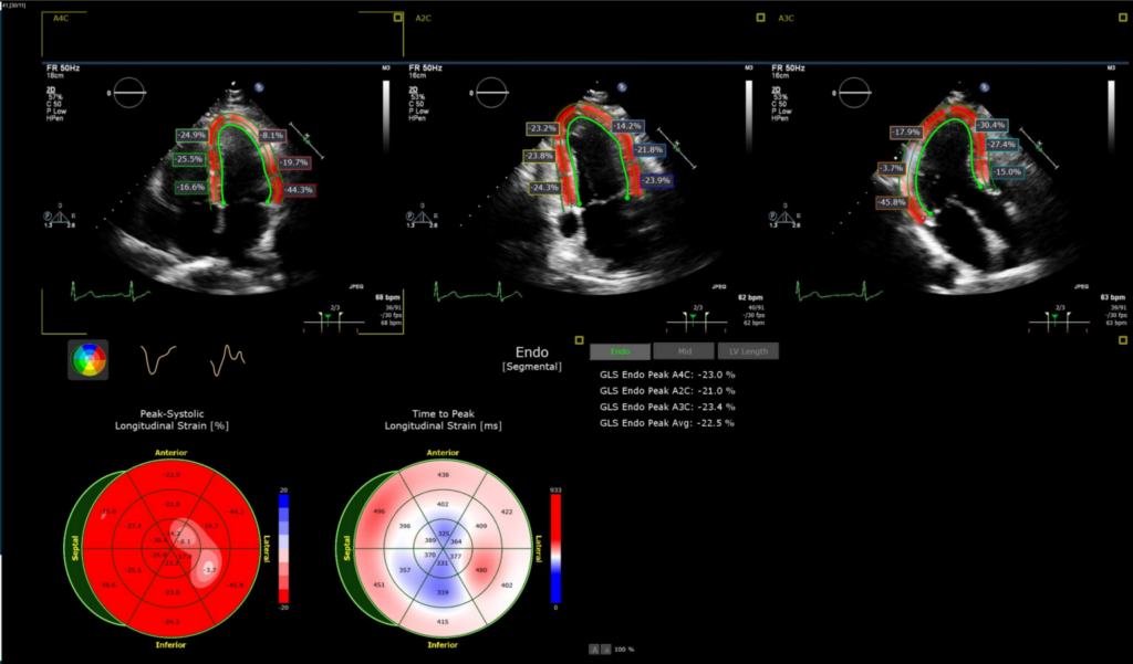 LV strain analysis philips ultrasound workspace picom365